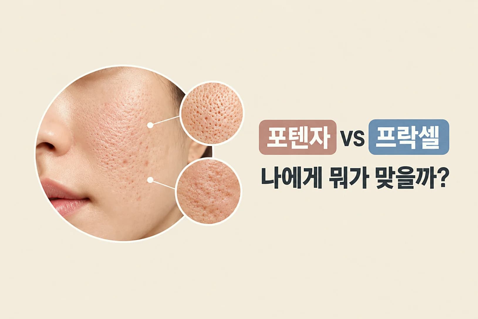 포텐자 프락셀 차이 모공 흉터 효과와 선택 기준을 소개하는 정보글 썸네일